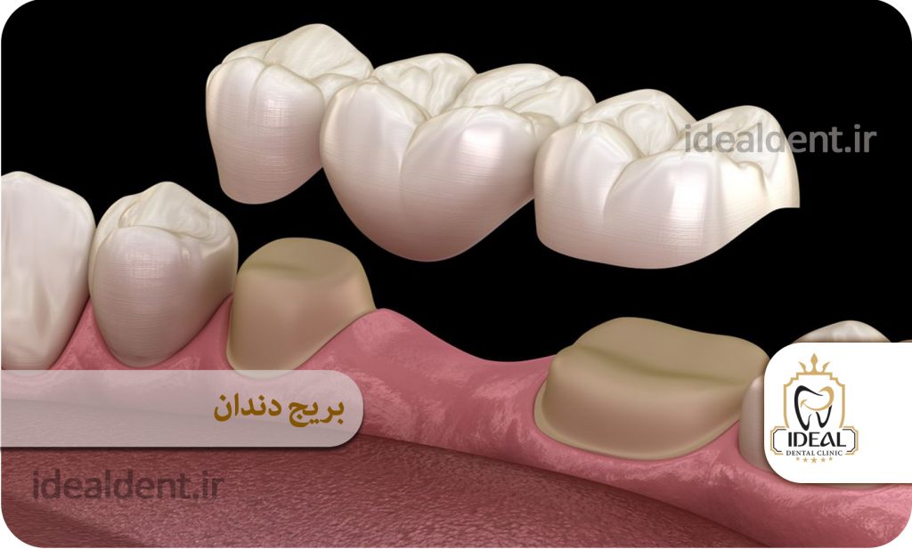 بریج روکش دندان غرب تهران